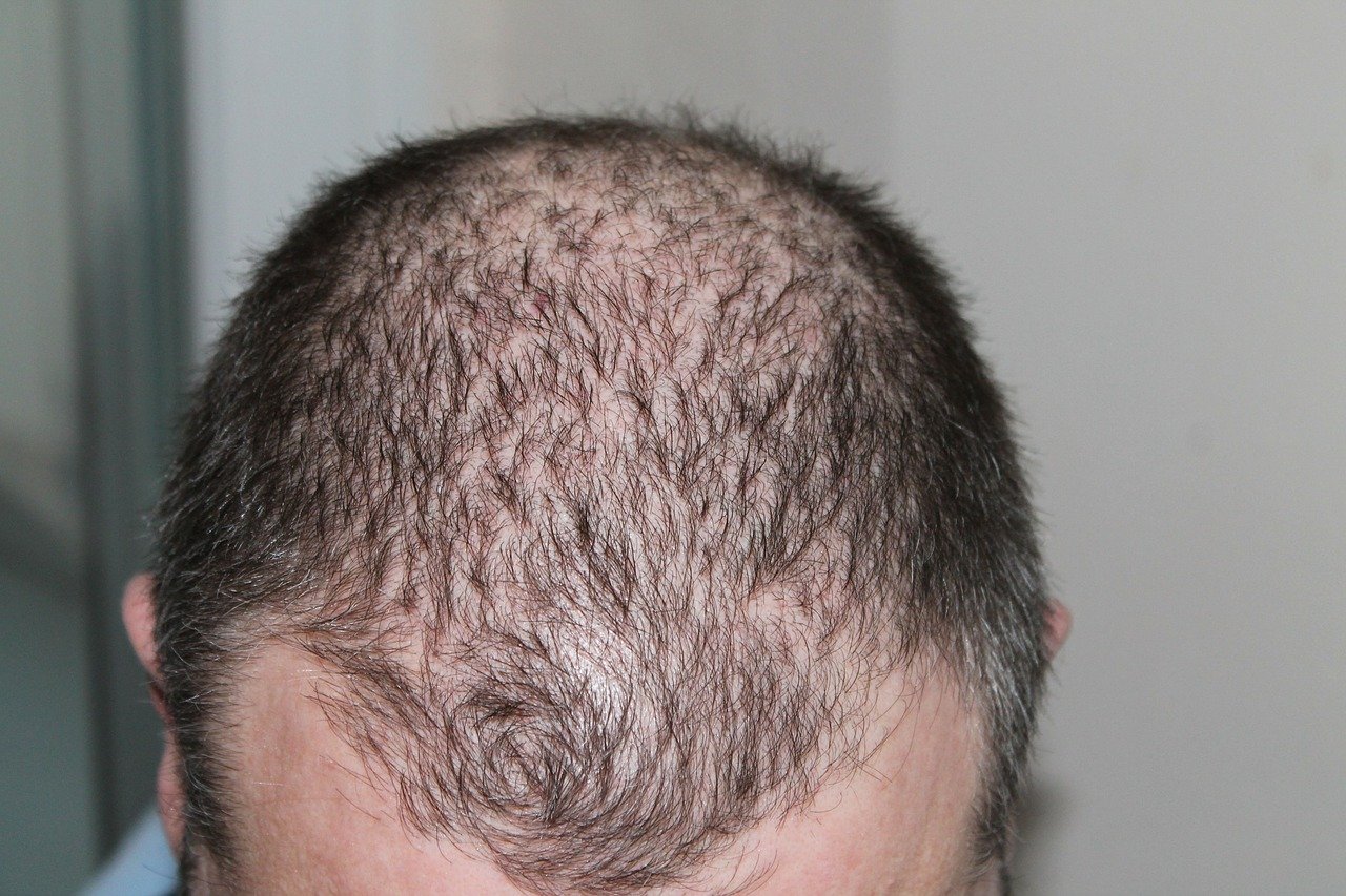 alopecija